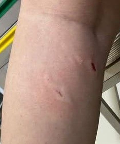 Kastamonu'da sahipsiz köpek lise öğrencisini bacağından ısırdı