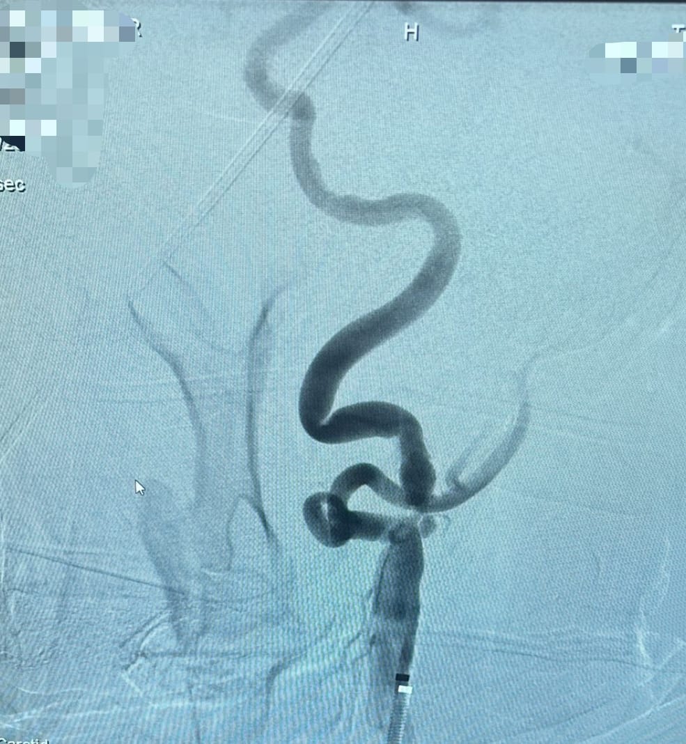 Kastamonu’da Şah Damarı Darlıklarına Stentle Müdahale Başladı (2)