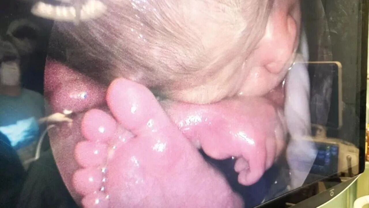 Kastamonulu Anne Ve Bebeği Tıp Tarihine Geçti!4